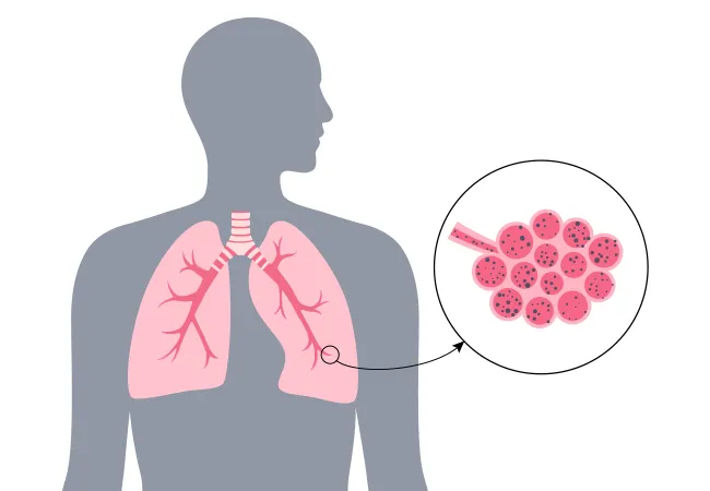 inalazione polveri alluminio inalazione polveri alluminio